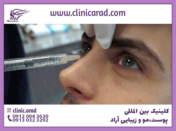 تزریق آنزیم بینی برای اصلاح فرم بینی مرد جوان