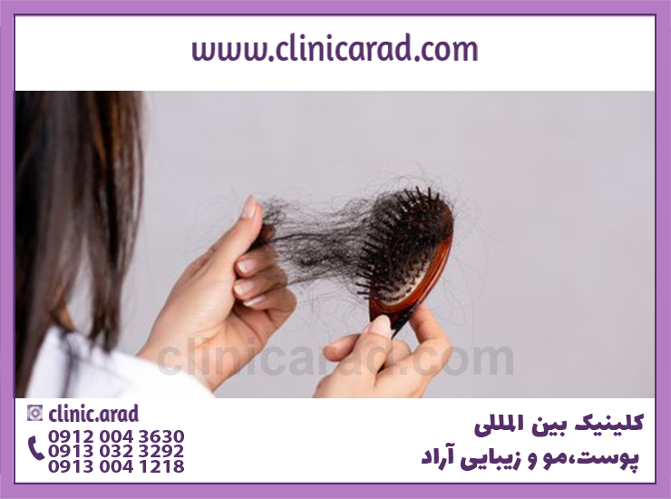 ریزش موی هورمونی چگونه درمان میشود؟